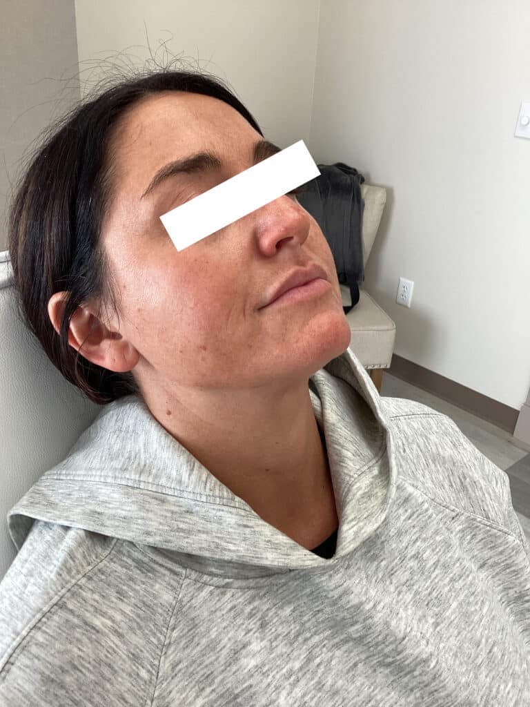 Before Image: Lip Filler - front