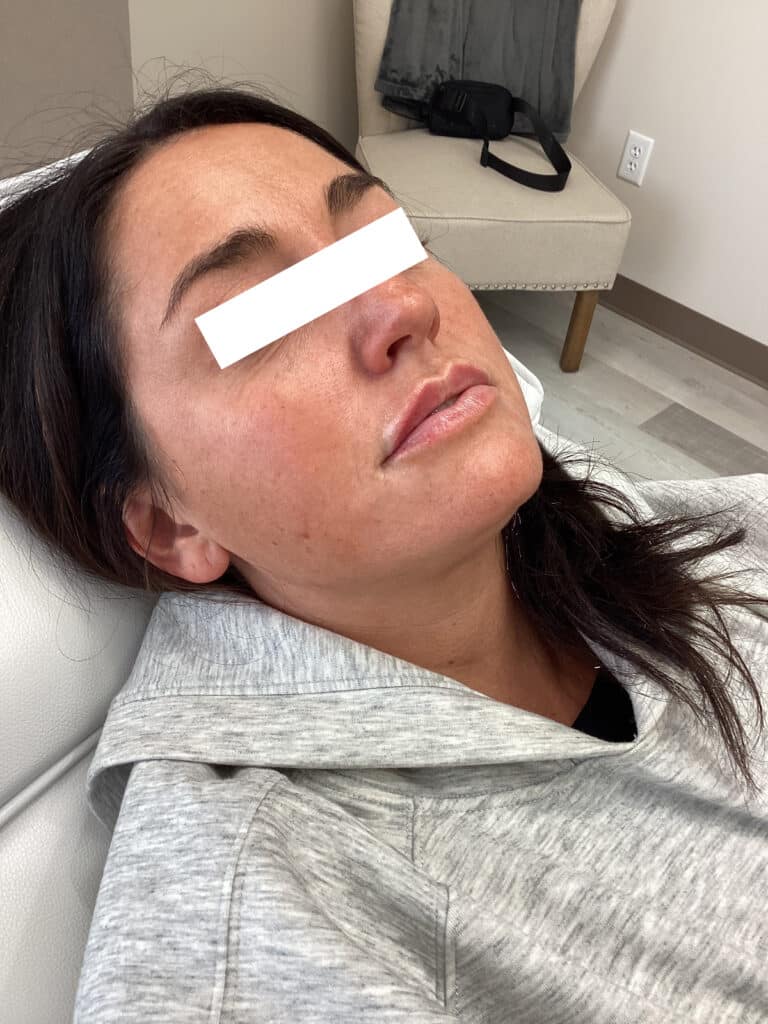 After Image: Lip Filler - front