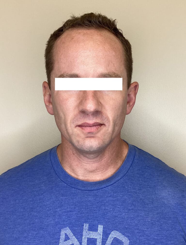 Before Image: Halo - front