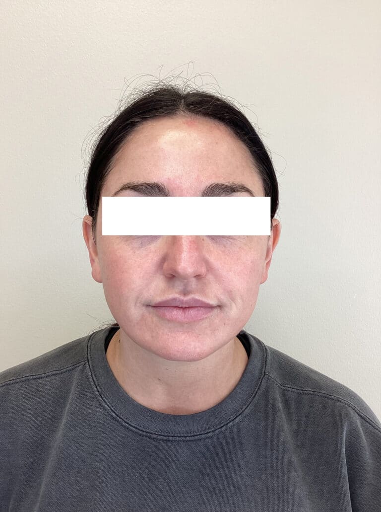 After Image: Dermapeel - front