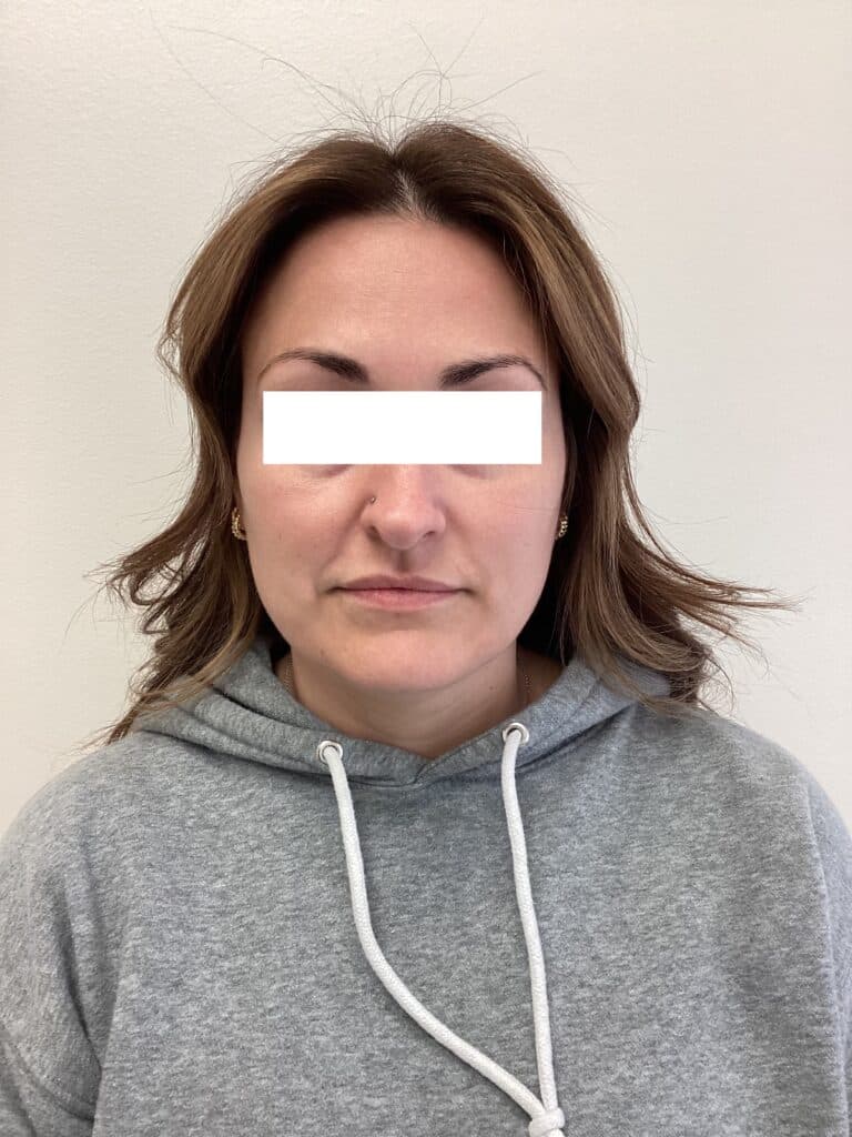 Before Image: Tear Through Filler - front